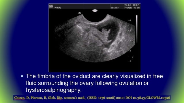 Role of us in evaluation of infertility Dr. Muhammad Bin Zulfiqar