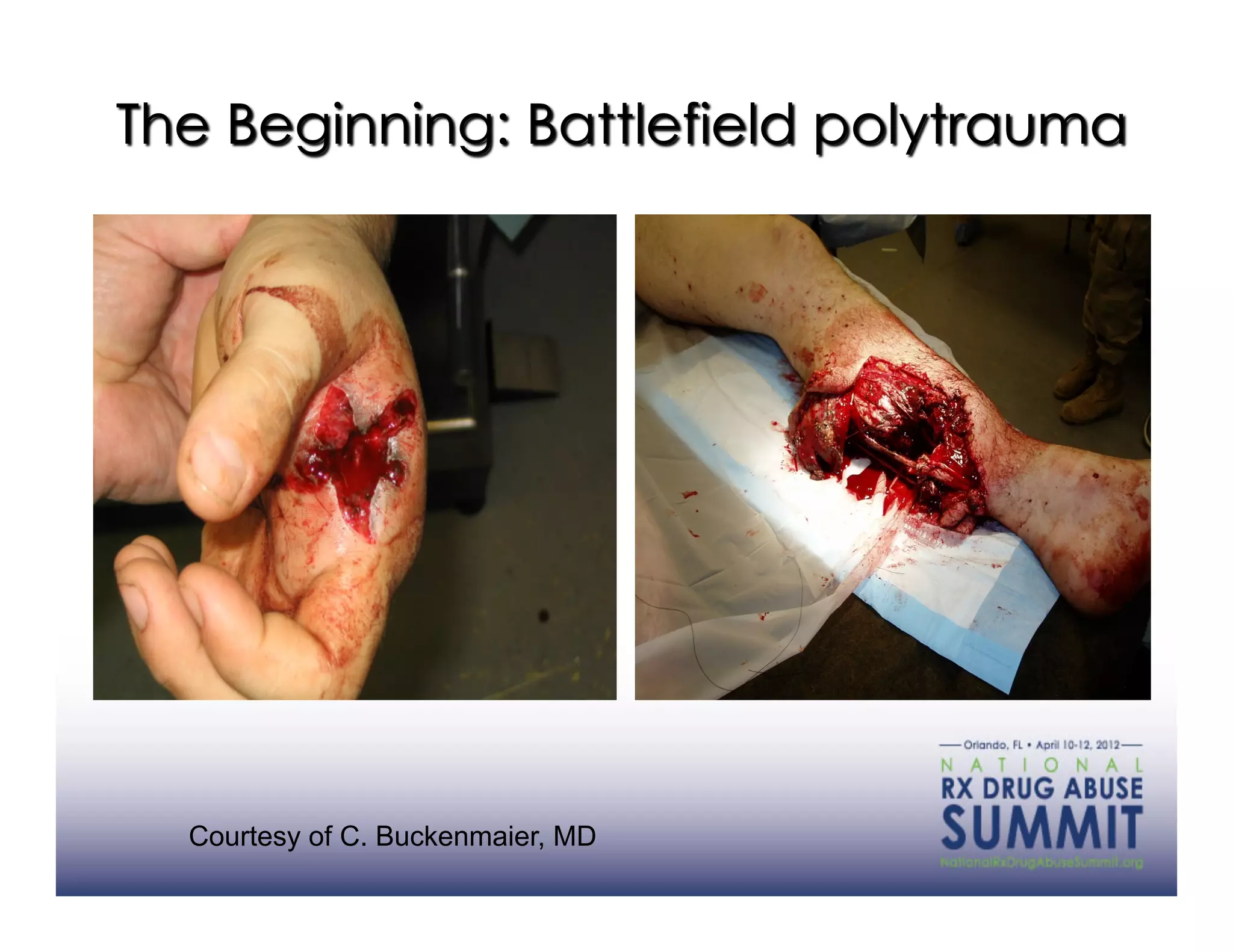 Courtesy of C. Buckenmaier, MD
 