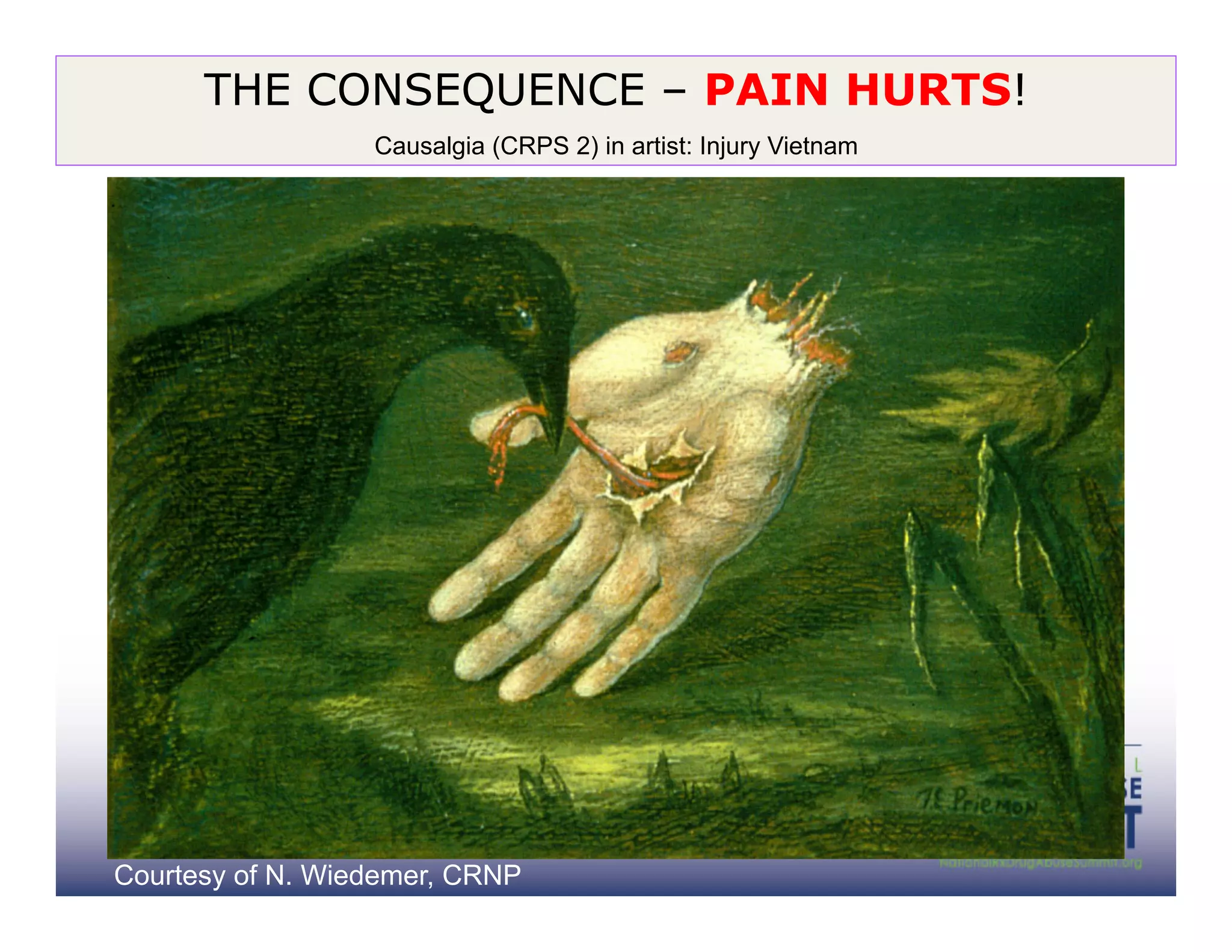 THE CONSEQUENCE – PAIN HURTS!
                  Causalgia (CRPS 2) in artist: Injury Vietnam




Courtesy of N. Wiedemer, CRNP
 