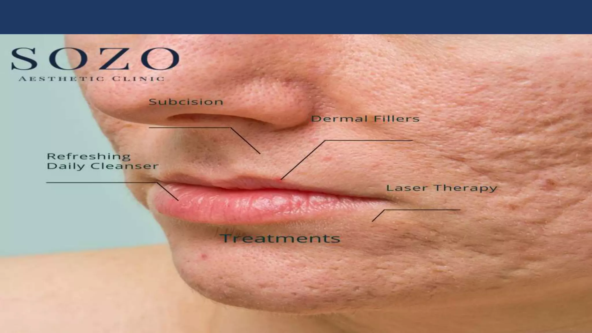 Rolling Scars What is it and Their Treatments? PPT