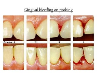 Gingival bleeding on probing
 