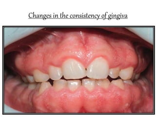 Changes in the consistency of gingiva
 