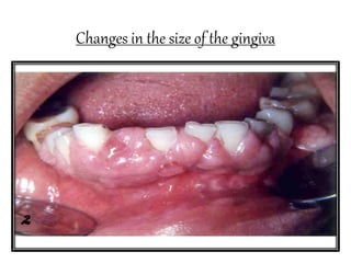 Changes in the size of the gingiva
 