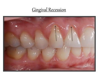 Gingival Recession
 
