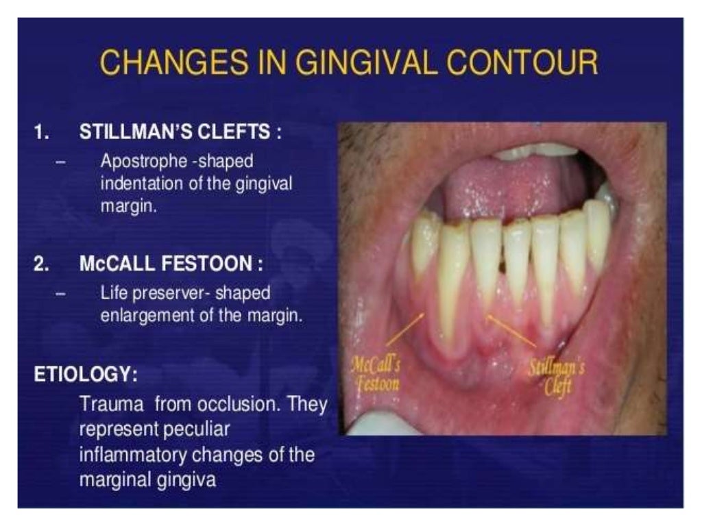 clinical features of gingivitis