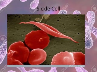 Sickle Cell
 