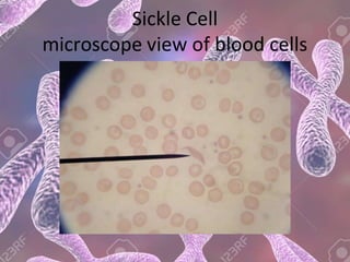 Sickle Cell
microscope view of blood cells
 