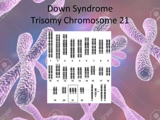 Down Syndrome
Trisomy Chromosome 21
 