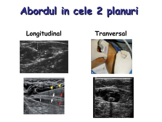 Abordul in cele 2 planuriAbordul in cele 2 planuri
Longitudinal Tranversal
Image courtesy of Carolyn
Menendez, MD
 
