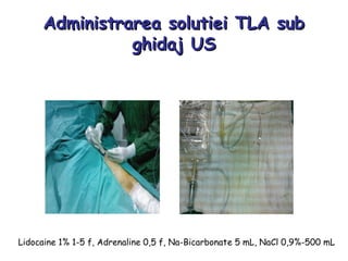 Administrarea solutiei TLA subAdministrarea solutiei TLA sub
ghidaj USghidaj US
Lidocaine 1% 1-5 f, Adrenaline 0,5 f, Na-Bicarbonate 5 mL, NaCl 0,9%-500 mL
 