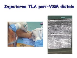 Injectarea TLA peri-VSM distalaInjectarea TLA peri-VSM distala
 