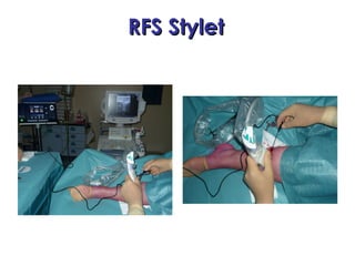 RFS StyletRFS Stylet
 