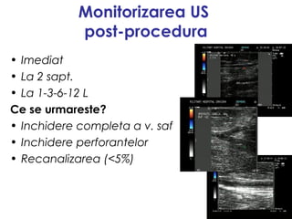 Monitorizarea US
post-procedura
• Imediat
• La 2 sapt.
• La 1-3-6-12 L
Ce se urmareste?
• Inchidere completa a v. saf
• Inchidere perforantelor
• Recanalizarea (<5%)
 