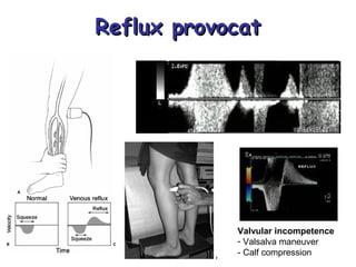 Reflux provocatReflux provocat
Valvular incompetence
- Valsalva maneuver
- Calf compression
 