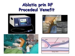 Ablatia prin RFAblatia prin RF
Procedeul VenefitProcedeul Venefit
 