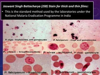 Jaswant Singh Battacharya (JSB) Stain for thick and thin films:
• This is the standard method used by the laboratories under the
National Malaria Eradication Programme in India
 