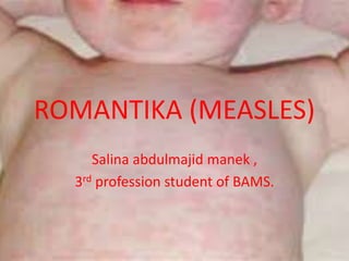 ROMANTIKA (MEASLES)
Salina abdulmajid manek ,
3rd profession student of BAMS.
 