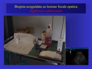 Biopsia ecoguidata su lesione focale epatica
Approccio sottocostale
 