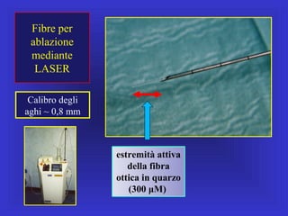 Fibre per
ablazione
mediante
LASER
Calibro degli
aghi ~ 0,8 mm
estremità attiva
della fibra
ottica in quarzo
(300 μM)
 