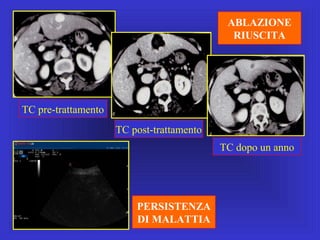 TC pre-trattamento
TC post-trattamento
TC dopo un anno
ABLAZIONE
RIUSCITA
PERSISTENZA
DI MALATTIA
 