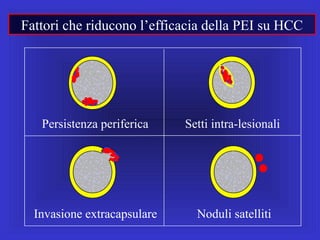 Fattori che riducono l’efficacia della PEI su HCC
Persistenza periferica Setti intra-lesionali
Noduli satellitiInvasione extracapsulare
 