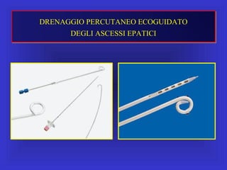 DRENAGGIO PERCUTANEO ECOGUIDATO
DEGLI ASCESSI EPATICI
 