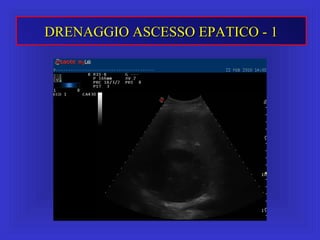 DRENAGGIO ASCESSO EPATICO - 1DRENAGGIO ASCESSO EPATICO - 1
 