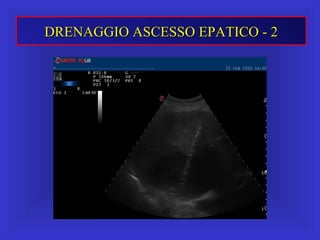 DRENAGGIO ASCESSO EPATICO - 2DRENAGGIO ASCESSO EPATICO - 2
 