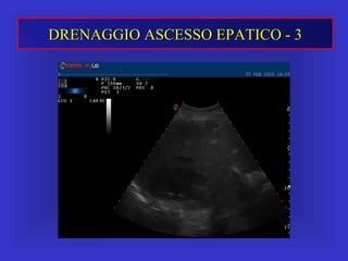 DRENAGGIO ASCESSO EPATICO - 3DRENAGGIO ASCESSO EPATICO - 3
 