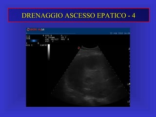 DRENAGGIO ASCESSO EPATICO - 4DRENAGGIO ASCESSO EPATICO - 4
 