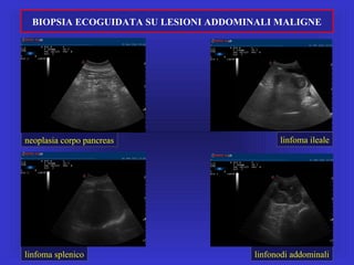 BIOPSIA ECOGUIDATA SU LESIONI ADDOMINALI MALIGNE
neoplasia corpo pancreas linfoma ileale
linfoma splenico linfonodi addominali
 