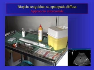 Biopsia ecoguidata su epatopatia diffusa
Approccio intercostale
 