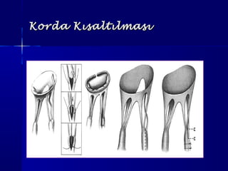 Korda KısaltılmasıKorda Kısaltılması
 