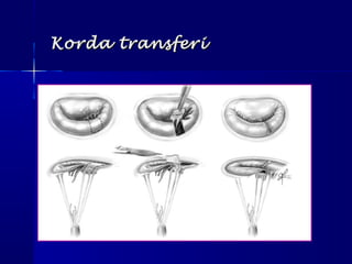 Korda transferiKorda transferi
 