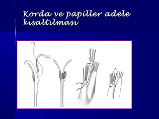 Korda ve papiller adeleKorda ve papiller adele
kısaltılmasıkısaltılması
 