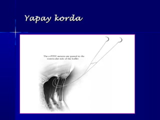 Yapay kordaYapay korda
 