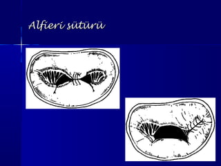 Alfieri sütürüAlfieri sütürü
 
