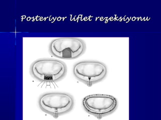 Posteriyor liflet rezeksiyonuPosteriyor liflet rezeksiyonu
 