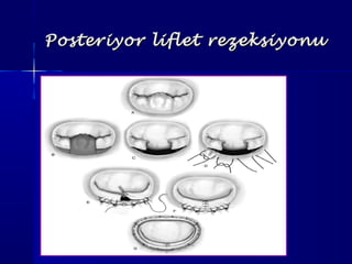 Posteriyor liflet rezeksiyonuPosteriyor liflet rezeksiyonu
 