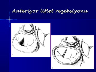 Anteriyor liflet rezeksiyonuAnteriyor liflet rezeksiyonu
 