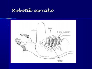 Robotik cerrahiRobotik cerrahi
 