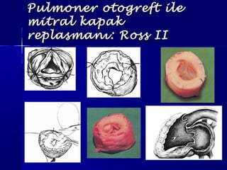 Pulmoner otogreft ilePulmoner otogreft ile
mitral kapakmitral kapak
replasmanı: Ross IIreplasmanı: Ross II
 