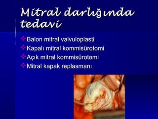 Mitral darlı ındağMitral darlı ındağ
tedavitedavi
Balon mitral valvuloplastiBalon mitral valvuloplasti
Kapalı mitral kommisürotomiKapalı mitral kommisürotomi
Açık mitral kommisürotomiAçık mitral kommisürotomi
Mitral kapak replasmanıMitral kapak replasmanı
 