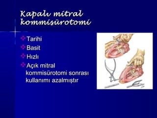 Kapalı mitralKapalı mitral
kommisürotomikommisürotomi
TarihiTarihi
BasitBasit
HızlıHızlı
Açık mitralAçık mitral
kommisürotomi sonrasıkommisürotomi sonrası
kullanımı azalmıştırkullanımı azalmıştır
 