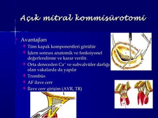 Açık mitral kommisürotomiAçık mitral kommisürotomi
 AvantajlarıAvantajları
 Tüm kapak komponentleri görülürTüm kapak komponentleri görülür
 İşlem sonrası anatomik ve fonksiyonelİşlem sonrası anatomik ve fonksiyonel
değerlendirme ve karar verilir.değerlendirme ve karar verilir.
 Orta dereceden CaOrta dereceden Ca++++
ve subvalvüler darlığıve subvalvüler darlığı
olan vakalarda da yapılırolan vakalarda da yapılır
 TrombüsTrombüs
 AF ilave cerrAF ilave cerr
 İlave cerr girişim (AVR, TR)İlave cerr girişim (AVR, TR)
 