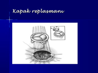 Kapak replasmanıKapak replasmanı
 