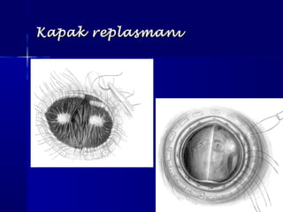 Kapak replasmanıKapak replasmanı
 