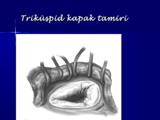 Triküspid kapak tamiriTriküspid kapak tamiri
 