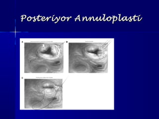 Posteriyor AnnuloplastiPosteriyor Annuloplasti
 