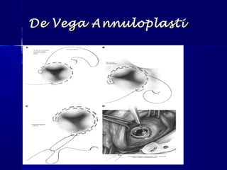 De Vega AnnuloplastiDe Vega Annuloplasti
 